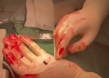 У Мережі показали вражаючі кадри, як хірургам вдалося дістати уламок із серця бійця ЗСУ (ВІДЕО)