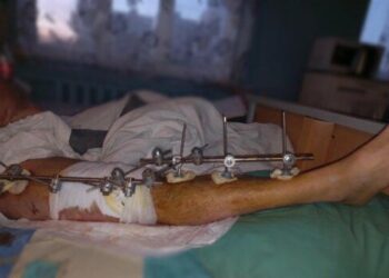 У Дніпрі молодому бійцю врятували життя та кінцівку, яка трималася на шині