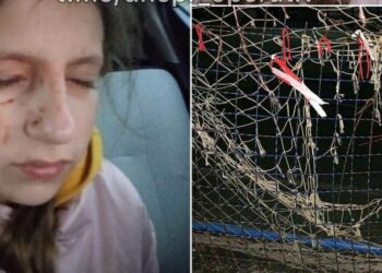У Новомосковську дитина ледь не втратила око на спортмайданчику