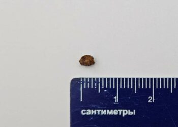 Шматок каменю у бронхах: лікарі розповіли про дивовижний порятунок малюка у Дніпрі